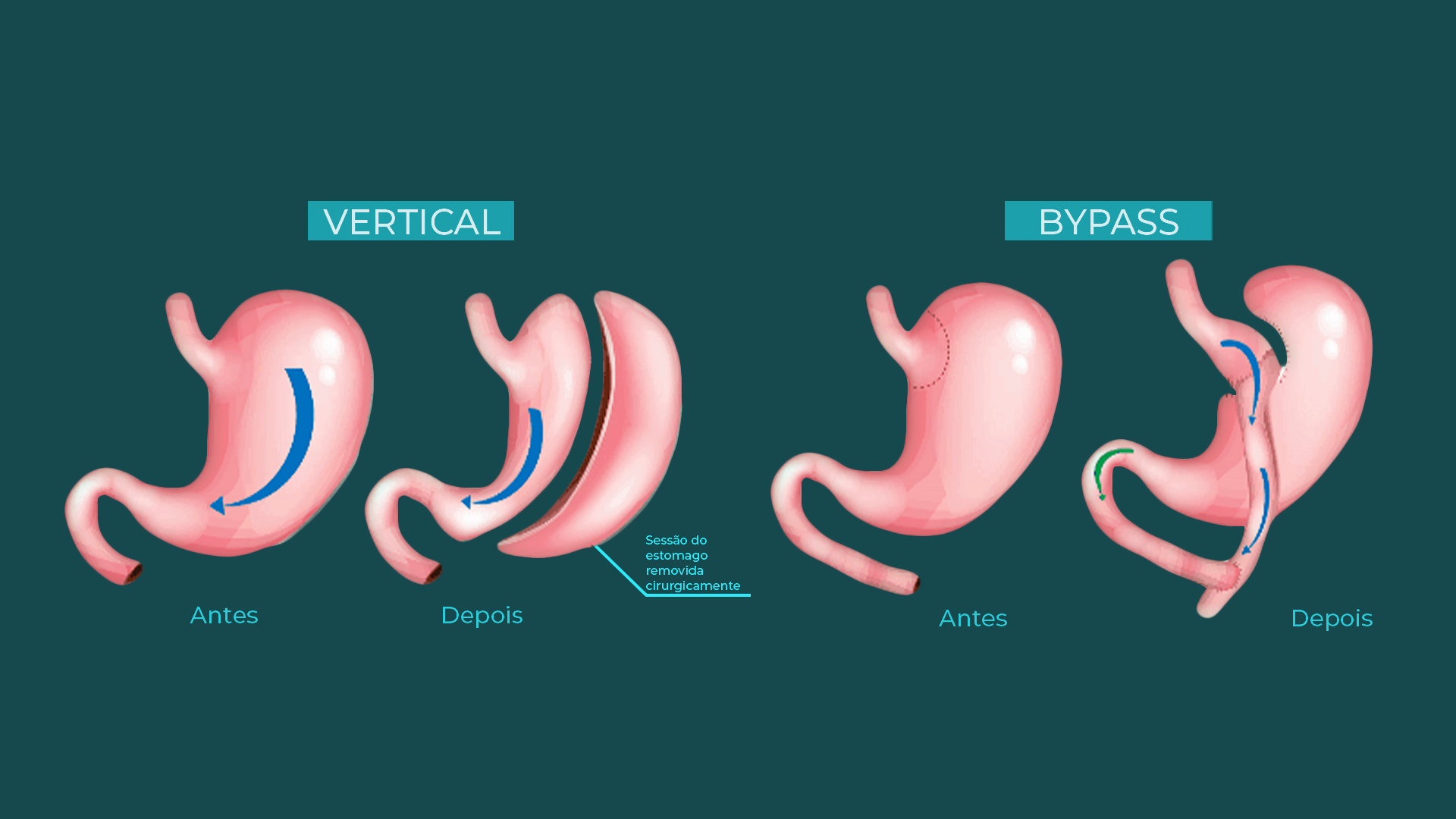 Passo a passo da realização de cirurgia bariátrica por vídeo